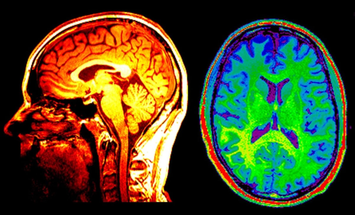 Advances in brain imaging settle debate over spread of key protein in Alzheimer’s