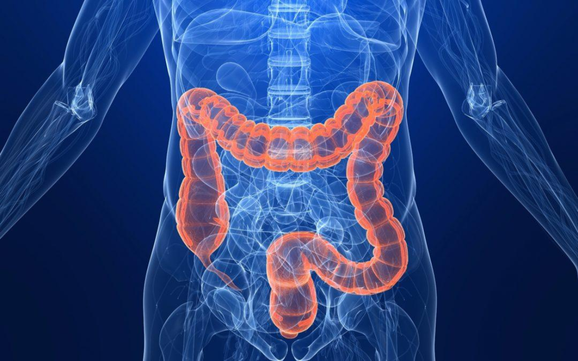 Colon cancer is caused by bacteria and cell stress